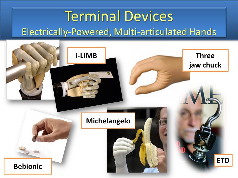 Occupational Therapy and the Upper Limb Amputee Joyce Tyler Hand, Upper