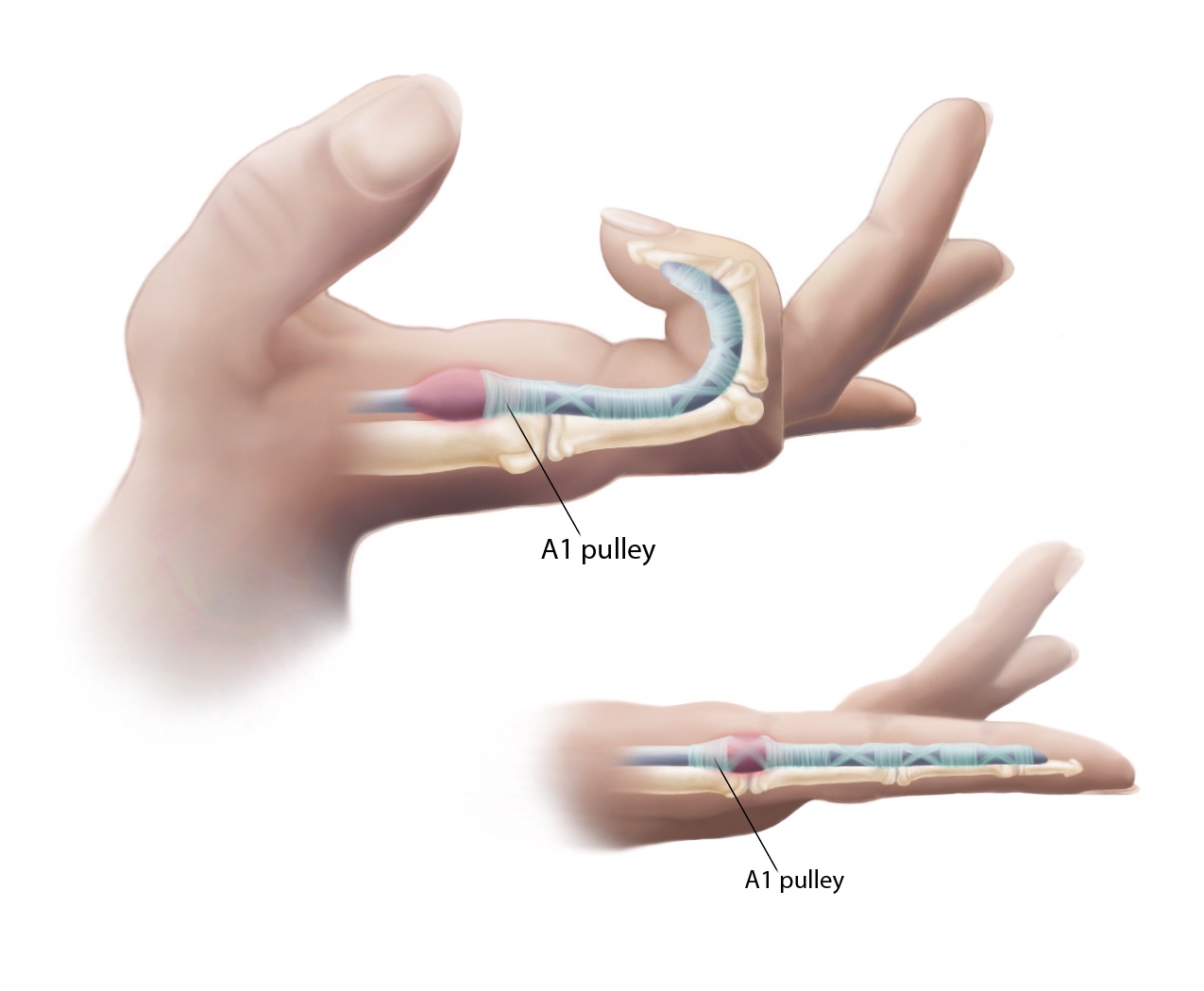 Trigger Finger or Trigger Thumb: Otherwise Known as Stenosing Tenosynovitis  - Premier Physical Therapy