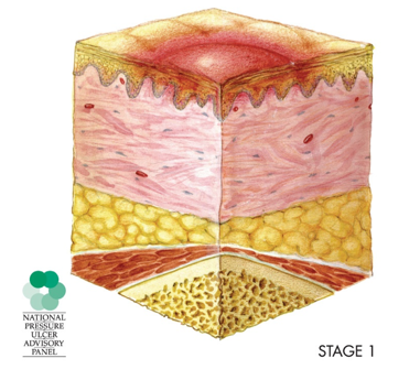 Anatomical drawing of the skin layers showing a stage one pressure injury