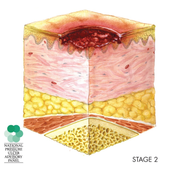Anatomical drawing of the skin layers showing a stage two pressure injury with loss of the dermis