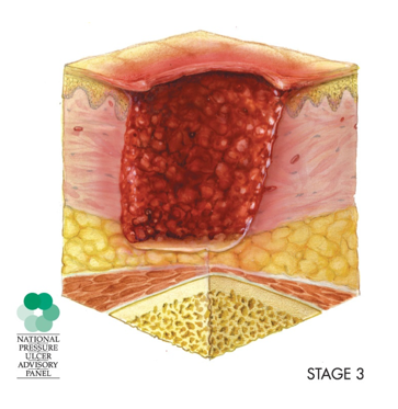 Anatomical drawing of the skin layers showing a stage three pressure injury with involvement of the epidermis and dermal layers