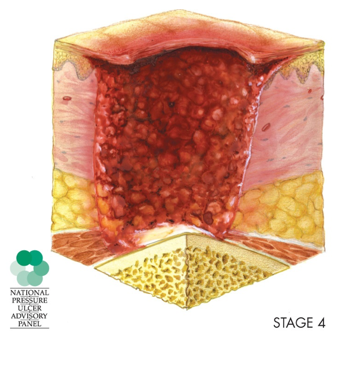 Anatomical drawing of the skin layers showing a stage four pressure injury with rull thickness tissue loss 