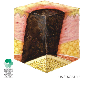 Anatomical drawing of the skin layers showing an unstageable pressure injury with full tissue loss and unknown depth