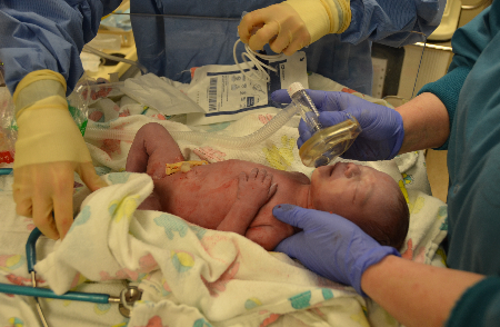 Newborn infant with nurses performing APGAR assessment 