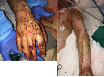 Examples of escharotomies