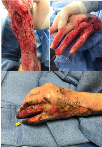 Degloving injury with friction burns affecting both side of forearm and