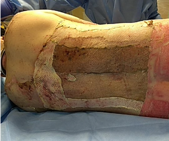 Example of an allograft