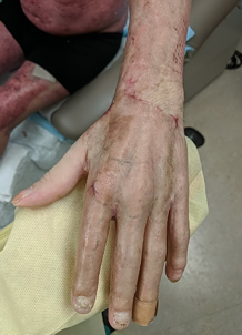 Example of burn post op 2 months