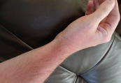 Example of a sunburn