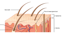 Superficial partial layer of epidermal and part of the dermal skin layer