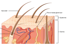 Deep partial layer of the skin with all of the epidermis and dermis