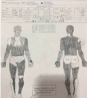 Example of Lund Browder chart for the case study