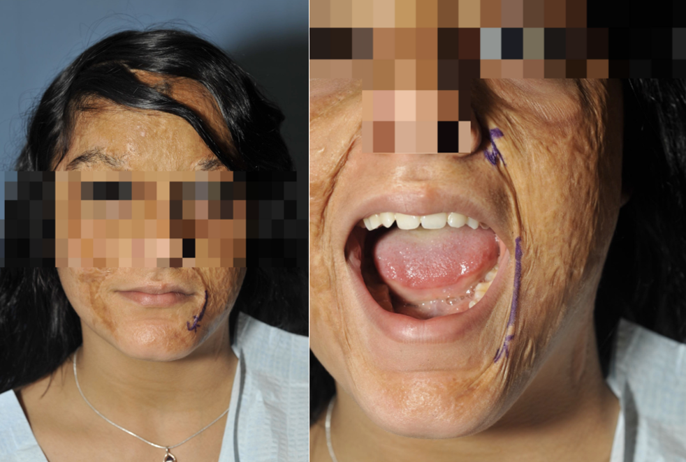 Facial graft and scarring