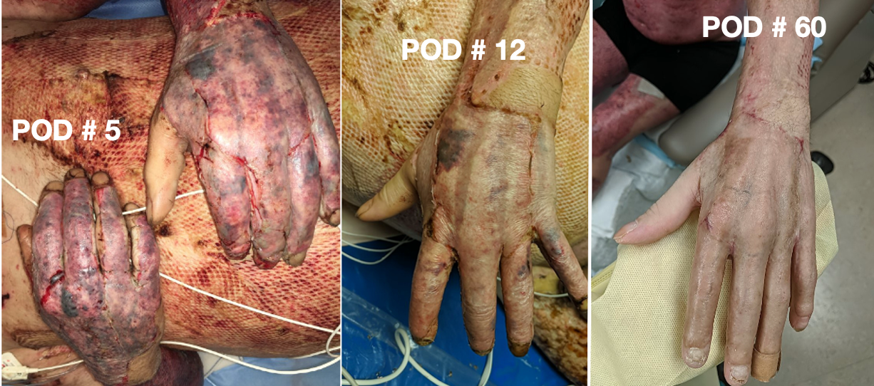 Progression of graft over time