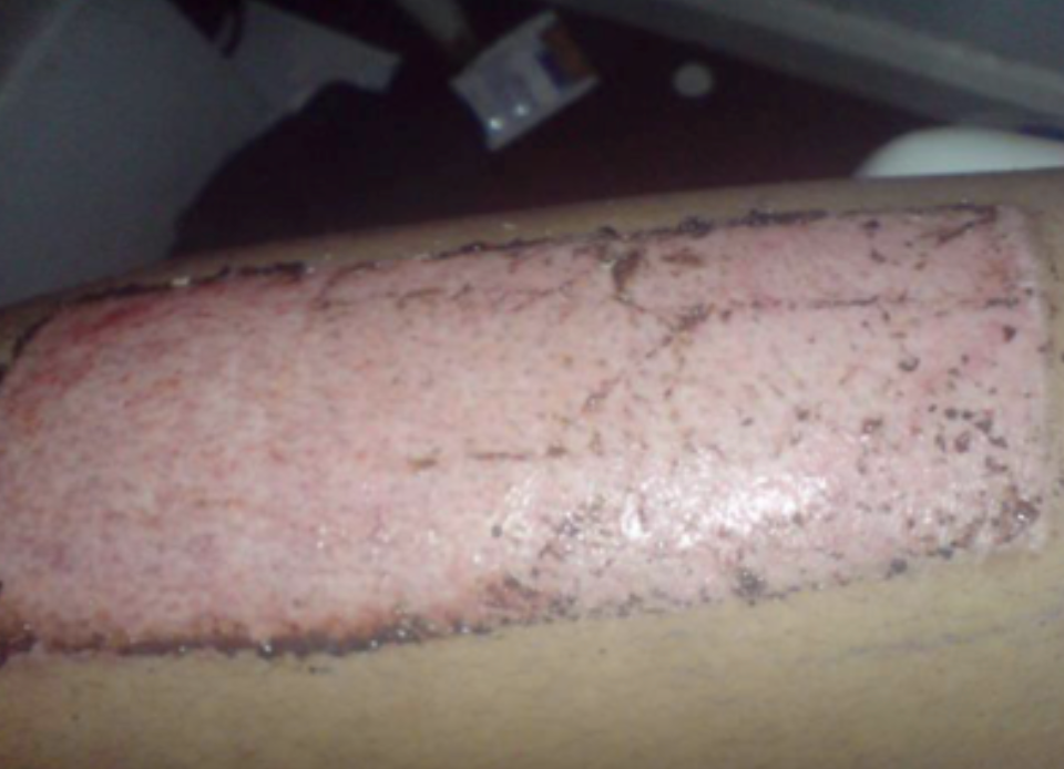 Example of a donor site on a leg