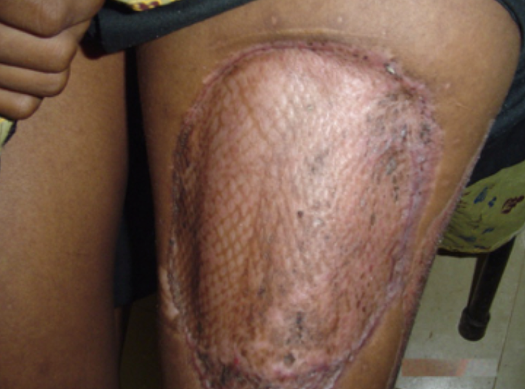 Mesh appearance in a scar