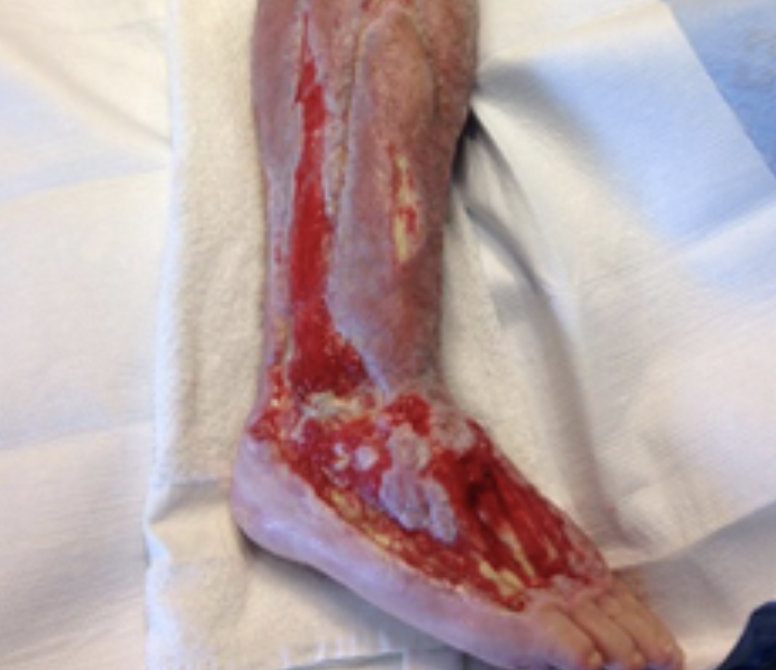 Example of granulation tissue on a healing right leg