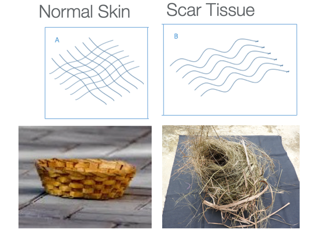 Examples of collagen fibers in both normal and scar tissue