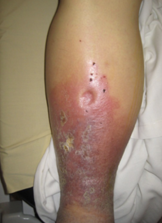 Example of pitting edema in a leg