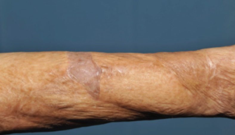 Forearm contracture example due to scarring