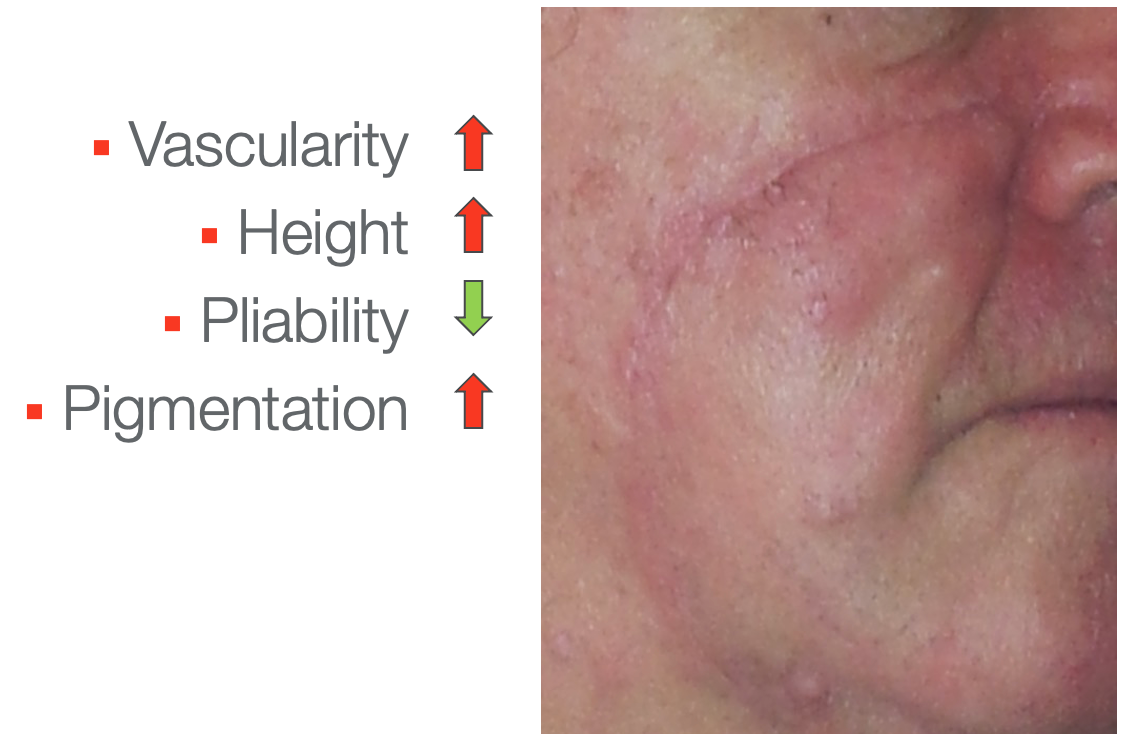 Scar example on a face