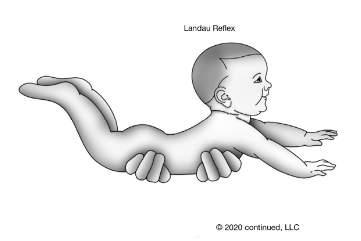 Drawing of the Landau reflex with the child held in prone