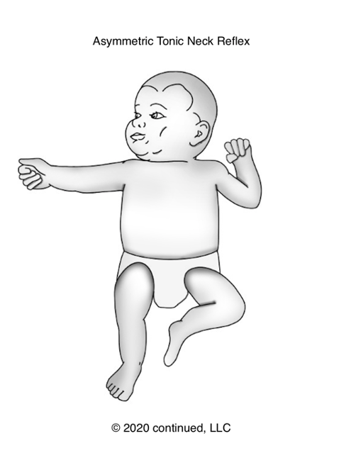 Drawing of the Asymmetric Tonic Neck Reflex in an infant