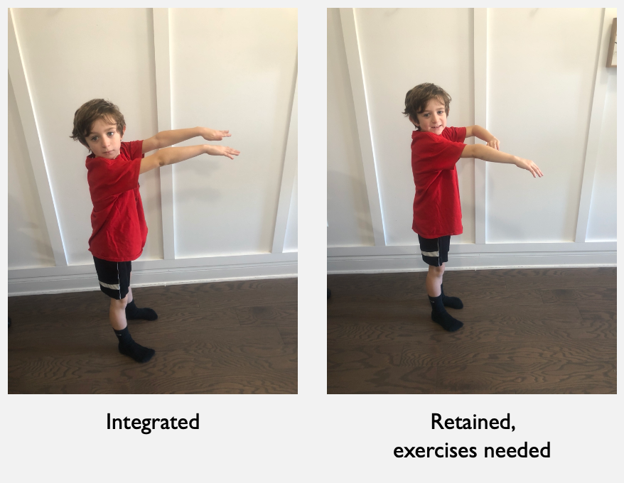 Testing for the ATNR reflex in standing with arms extended in front