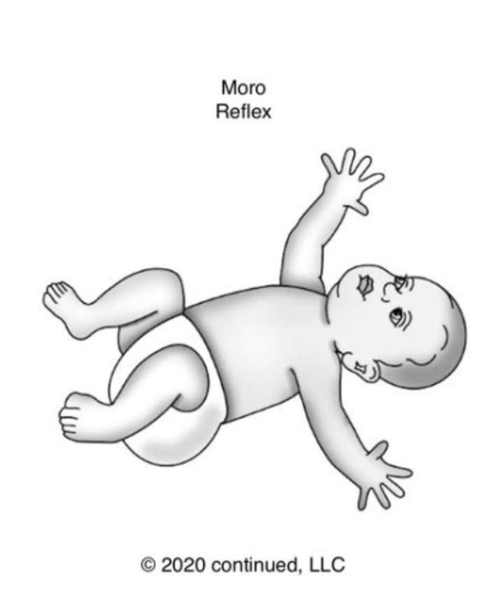 Drawing of the Moro reflex