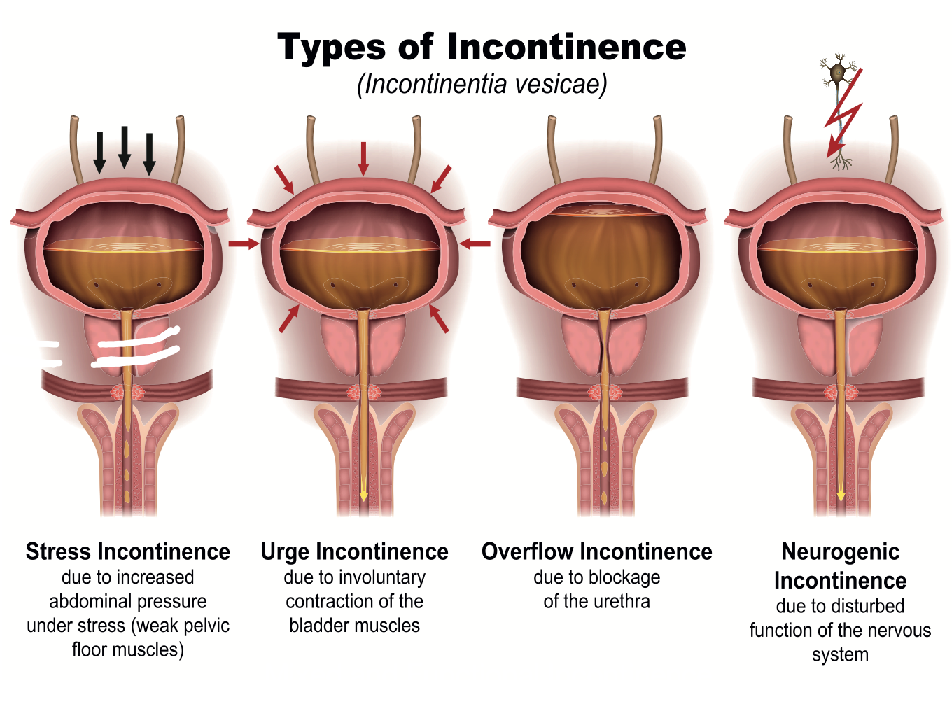 Unique, intensive curriculum helps patients retrain pelvic floor