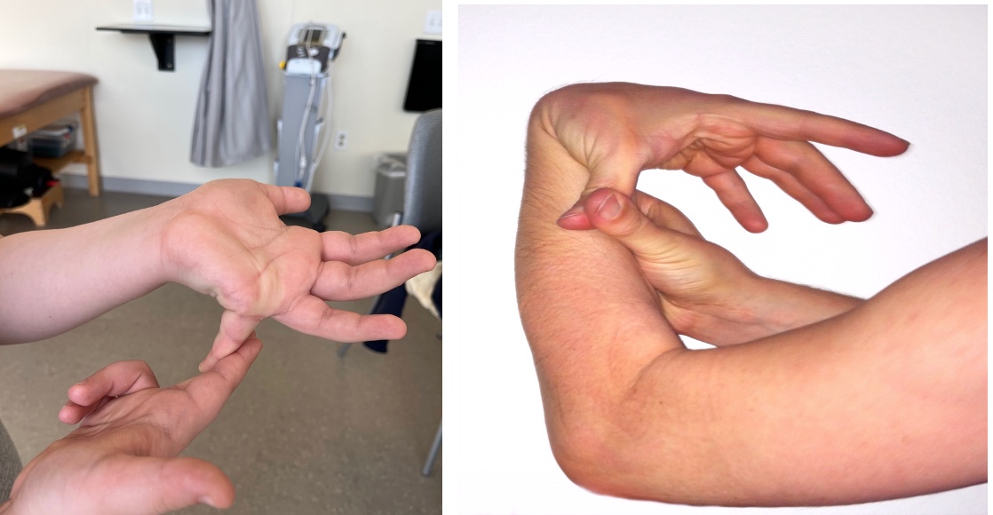 Benign Hypermobility Syndrome