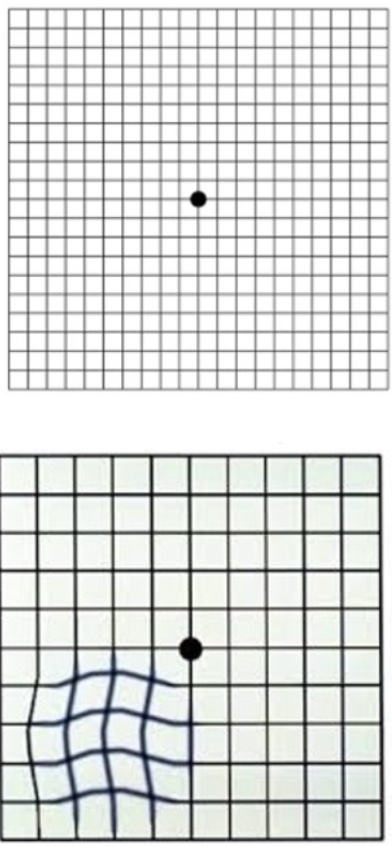 Canadian Association of Optometrists on X: Early signs of  #maculardegeneration can include waviness, distortion, blurring or missing  areas on the Amsler grid. These changes may indicate a problem or worsening  of #AMD.